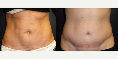 Tummy Tuck before and after photo