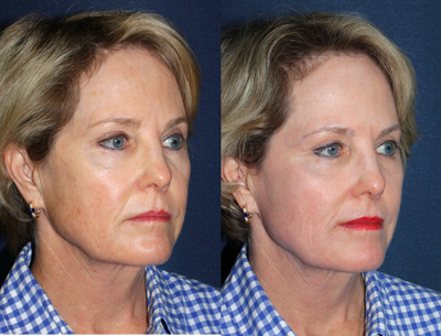 ActiveFX before and after photo