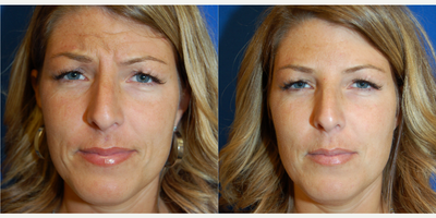 Botox before and after photo