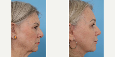 Brow Lift before and after photo