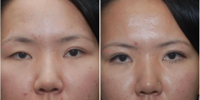 Double Eyelid Surgery before and after photo