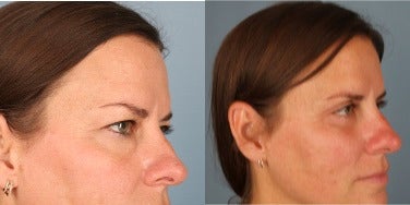 Double Eyelid Surgery before and after photo