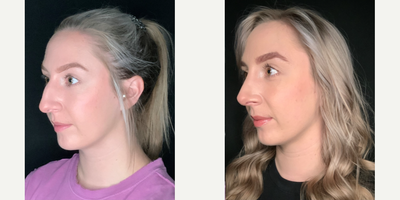 Rhinoplasty before and after photo