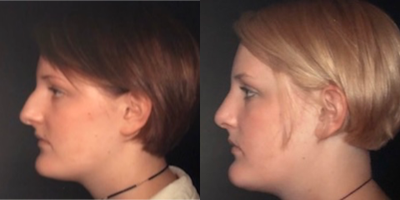 Rhinoplasty before and after photo