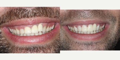 Tooth Repair before and after photo