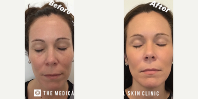 Dermal Fillers before and after photo