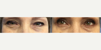 Dysport before and after photo