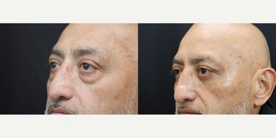 Eyelid Surgery before and after photo