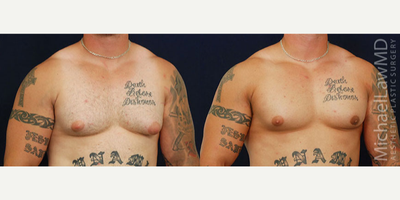 Gynecomastia Surgery before and after photo