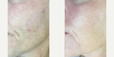 Microneedling before and after photo