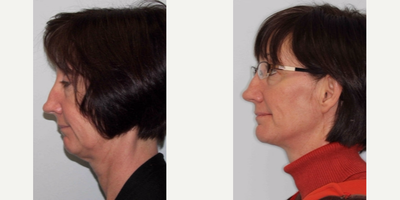 Nonsurgical Facelift before and after photo