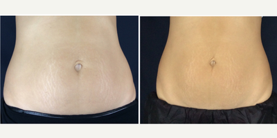 SculpSure before and after photo