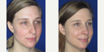 Septoplasty before and after photo