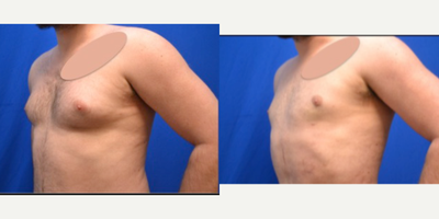Breast Reduction before and after photo