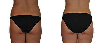 Butt Augmentation before and after photo