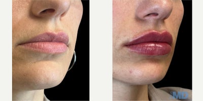 Dermal Fillers before and after photo