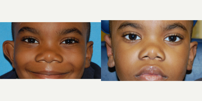 Earlobe Repair before and after photo
