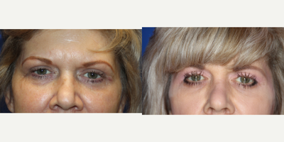 Eyelid Surgery before and after photo