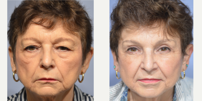 Eyelid Surgery before and after photo
