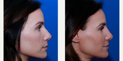 Nonsurgical Nose Job before and after photo