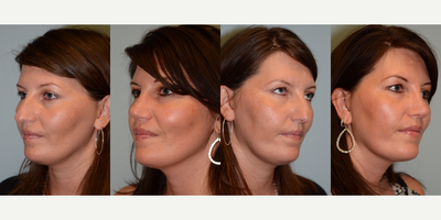 Revision Rhinoplasty before and after photo