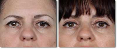 Eyelid Surgery before and after photo