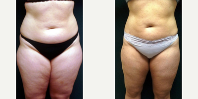 Liposuction before and after photo