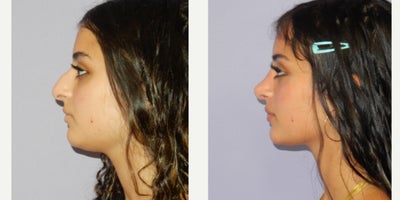 Rhinoplasty before and after photo