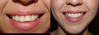 Braces before and after photo
