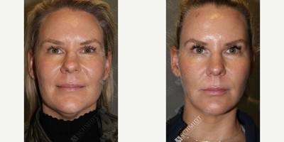 Chin Liposuction before and after photo