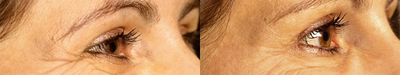 Dermal Fillers before and after photo