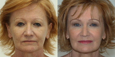 Liquid Facelift before and after photo
