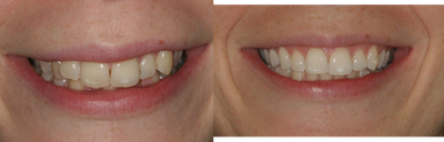 Smile Makeover before and after photo