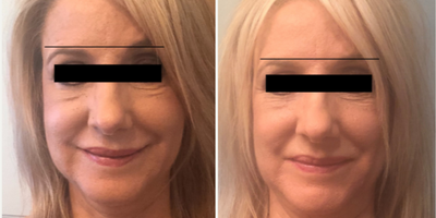 Botox before and after photo