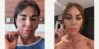 Facelift before and after photo