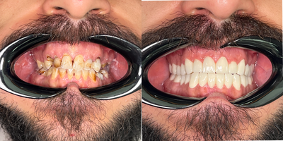Full Mouth Reconstruction before and after photo
