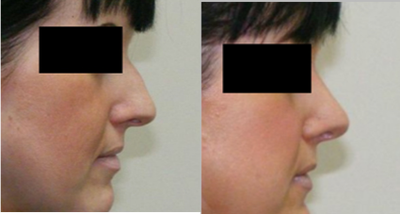 Rhinoplasty before and after photo