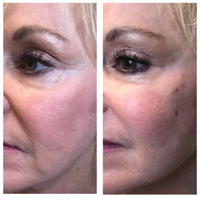 Thread Lift before and after photo