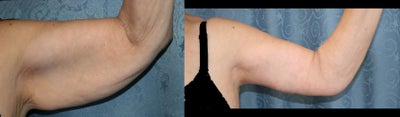 Arm Lift before and after photo