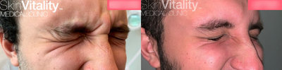Botox before and after photo