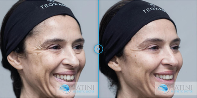 Botox before and after photo