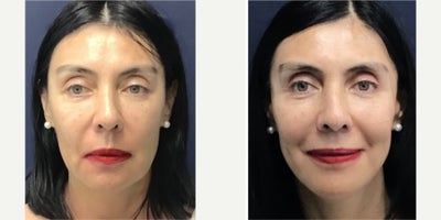 Deep Plane Facelift before and after photo