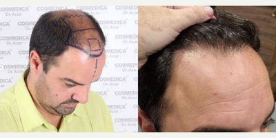Hair Loss Treatment before and after photo
