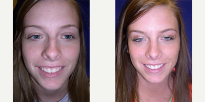 Rhinoplasty before and after photo