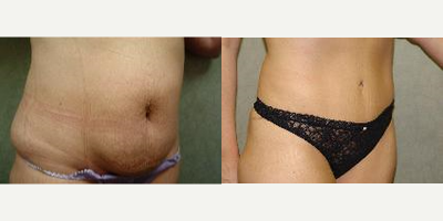 Tummy Tuck before and after photo
