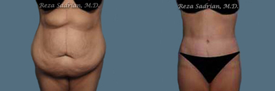 Body Lift before and after photo