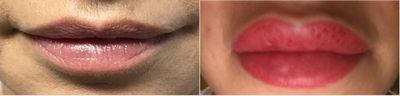 Juvederm before and after photo