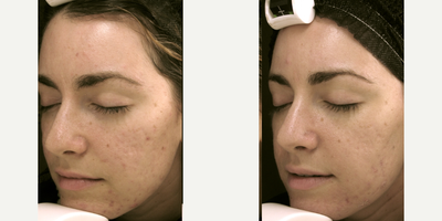 Microneedling before and after photo