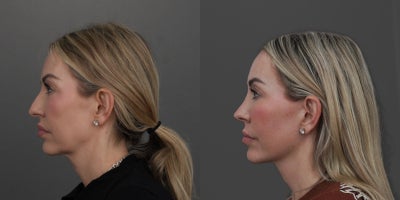 Rhinoplasty before and after photo