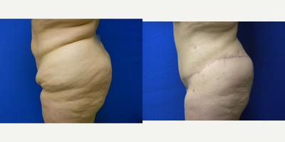 Body Lift before and after photo